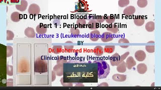 Part1  Peripheral Blood Film Lecture 3 Leukemoid blood picture [upl. by Faith]