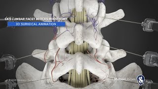 3D Animation of Lumbar Facet Rhizotomy Details Injection Procedure For Pain Relief [upl. by Bleier]