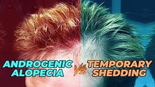 How To Test If Your Hair Loss Is Androgenic Alopecia Or Temporary Shedding [upl. by Nager]