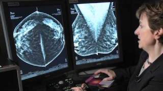 Innovations In Breast Cancer Detection 3D Mammography [upl. by Cornelia]