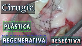 Cirugía periodontal resectiva regenerativa y plástica cirugiabucal periodoncia extraccion [upl. by Goddart550]