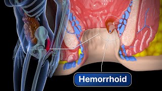 Hemorrhoid Removal  Step by step [upl. by Aenert147]