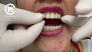 This dental prosthesis does not fall out of your mouth prótesisdental odontologia prótesis [upl. by Nahs]