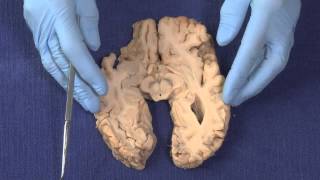 Basal Ganglia Neuroanatomy Video Lab  Brain Dissections [upl. by Arman]