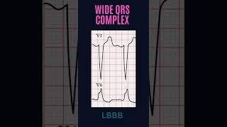 ECG FUNDAMENTALS FOR BEGINNERS QRS COMPLEX [upl. by Baal401]