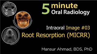 Cervical Root Resorption MICRR Intraoral Radiographic Interpretation [upl. by O'Kelly]