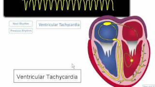 ECG Rhythm Review Ventricular Tachycardia Torsades de points Asystole [upl. by Zwart515]