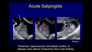 Ultrasound of the Fallopian Tube [upl. by Mason]