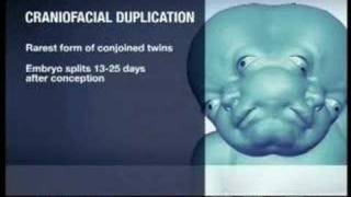 Two Faced Baby  Lali Was Born With Craniofacial Duplication [upl. by Kelcey]