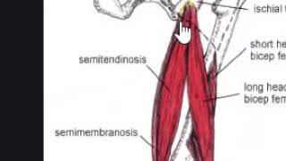 Semimembranosus tendon tear from the hamstring tendon origin [upl. by Evot]