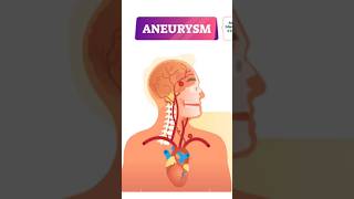 ANEURYSM  nursingstudent nursingeducation medicalsurgicalnursing subscribe youtubeshorts [upl. by Eecyac]