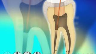 Endodontic Root Canal Disinfection  Waterlase Laser Dentistry [upl. by Evangelia809]