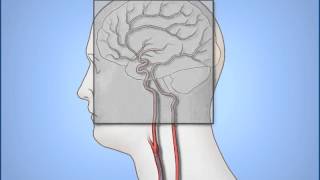 Diagnostic Cerebral Angiography [upl. by Acker]