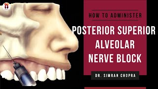 Posterior Superior Alveolar Nerve Block l PSA Nerve Block Technique l Nerve Block Injection [upl. by Alamac]