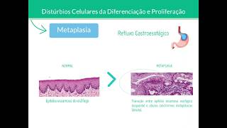 Metaplasia e Displasia  Patologia [upl. by Tapes815]