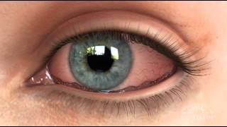 Conjunctivochalasis CCH Dry Eye Animation [upl. by Beaulieu]