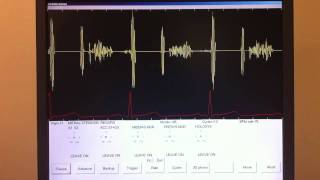 Mitral Stenosis [upl. by Suzy]