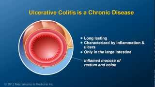 What is Ulcerative Colitis [upl. by Waligore]