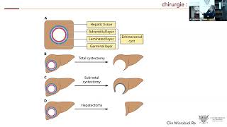 La chirurgie de l’échinococcose kystique hépatique [upl. by Amitaf]