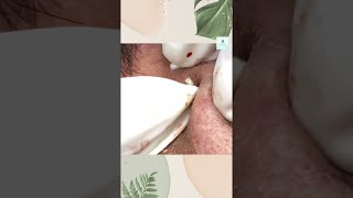 Big Cystic Acne Blackheads Extraction Blackheads amp Milia Whiteheads Removal Pimple Popping shorts [upl. by Brebner]