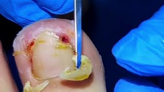 Patient Screams When Huge Ingrown Toenails Get Pulled By Pedicurist [upl. by Manvell764]