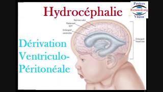 Hydrocéphalie et dérivation ventriculopéritonéale du liquide cérébrospinal [upl. by Enamrahs]