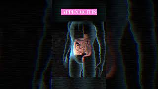 Appendicitis explained in this video shorts appendicitis appendix humanbody [upl. by Enyale146]