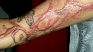 Tattooremoval procedures leave clients scarred for life [upl. by Rivy119]