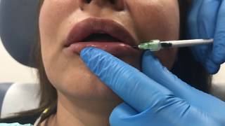 Reversing poorly placed lip filler using Hylenex hyaluronidase [upl. by Carolyne]