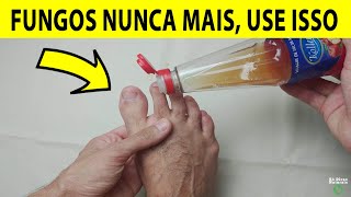 O FIM DA MICOSE E FUNGOS NAS UNHAS Basta 5 Gotas Disso Para Eliminar em 3 Dias [upl. by Aihtebat]