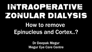 Intraoperative Zonular Dialysis How to remove Epinucleus and Cortex  Dr Deepak Megur [upl. by Devondra]