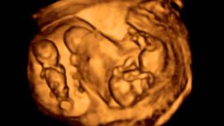 3D ultrasound Dichorionic triamniotic triplets 12 weeks [upl. by Allertse]