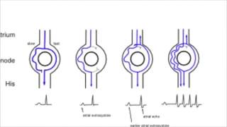 AVNRT AV nodal reentrant tachycardia [upl. by Gillan]