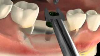 Cirurgia de implante dentário  Vídeo da técnica  São Paulo SP [upl. by Grounds]