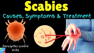 Scabies Causes Symptoms Diagnosis Treatment amp Prevention [upl. by Elag]