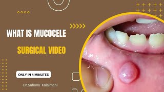 what is mucocele along with surgical procedure video  Dentist [upl. by Pevzner415]