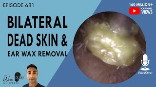 681  Bilateral Dead Skin amp Ear Wax Removal [upl. by Edette]