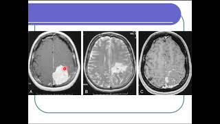 Introduction to interventional neuroradiology [upl. by Idnam626]