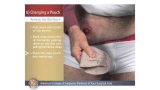 ColostomyIleostomy Changing a Pouch [upl. by Rastus]