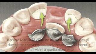 dott Montironi dentista  PONTE MARYLAND [upl. by Pavkovic]