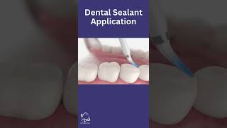 Dental Sealants Procedure Explained in 20 seconds  Seal the Deal [upl. by Adnolahs]