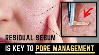 The truth of residual sebum enlarging our pores [upl. by Raskin]