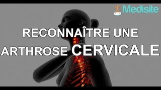 Reconnaître une arthrose cervicale [upl. by Haela926]