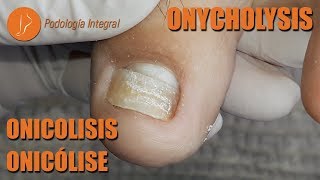 Onycholysis due to trauma podology asmr [upl. by Silsbye]