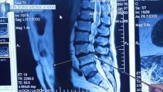 Degenerative Spondylolisthesis by Dr Tony Mork [upl. by Hampton]