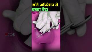 छोटे ऑपरेशन से बच्चा पैदा episiotomy delivery normaldeliverytips [upl. by Cire510]