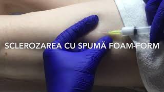 Scleroterapia cu spumă foamform a vaselor membrelor inferioare [upl. by February]