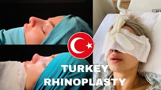 RHINOPLASTY NOSE JOB EXPERIENCE IN TURKEY  DR ERDEM ÇAĞLAR [upl. by Lletnahc]