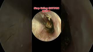 Deep Impacted Cerumen With Severely Swollen Ear Canal [upl. by Nryhtak]