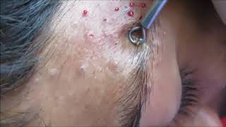 Tons of blackheads 17 minutes of extractionsBlackheads whiteheadsmilia Face and ears MrPopZit [upl. by Flory]